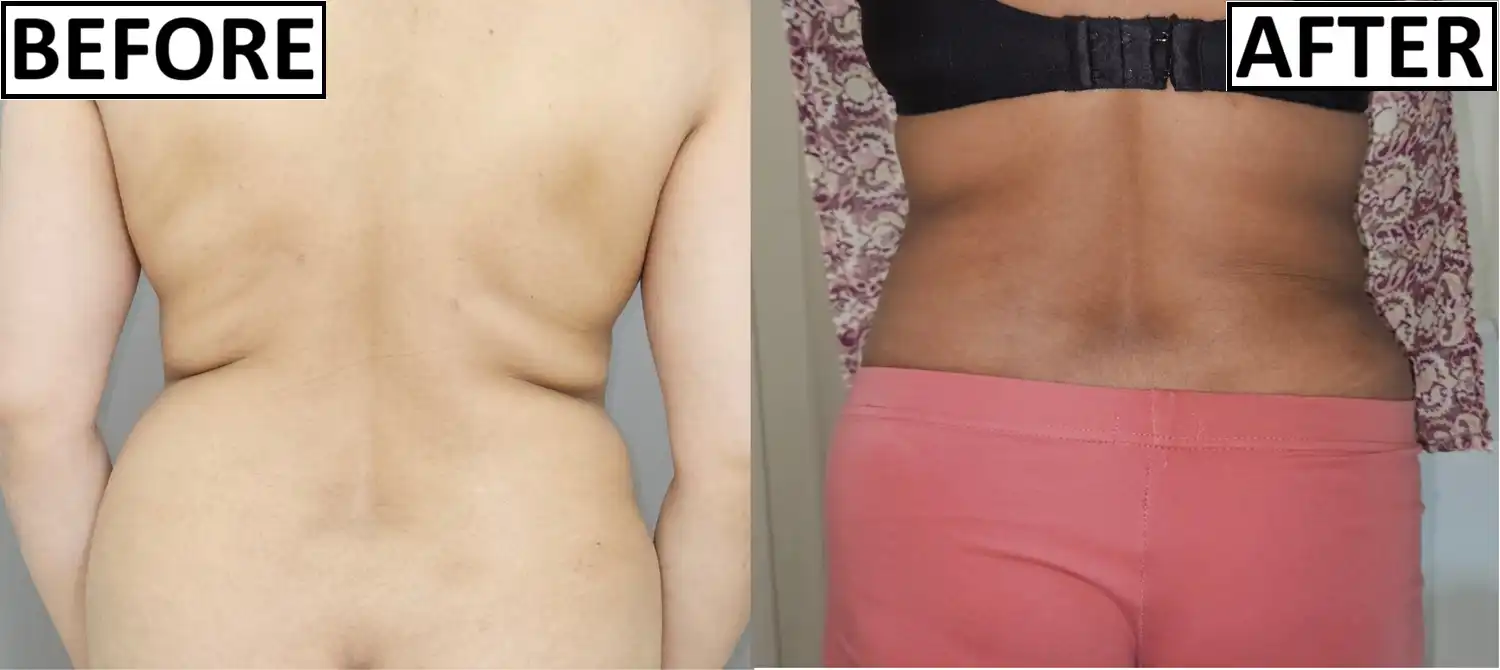 360-degree liposuction