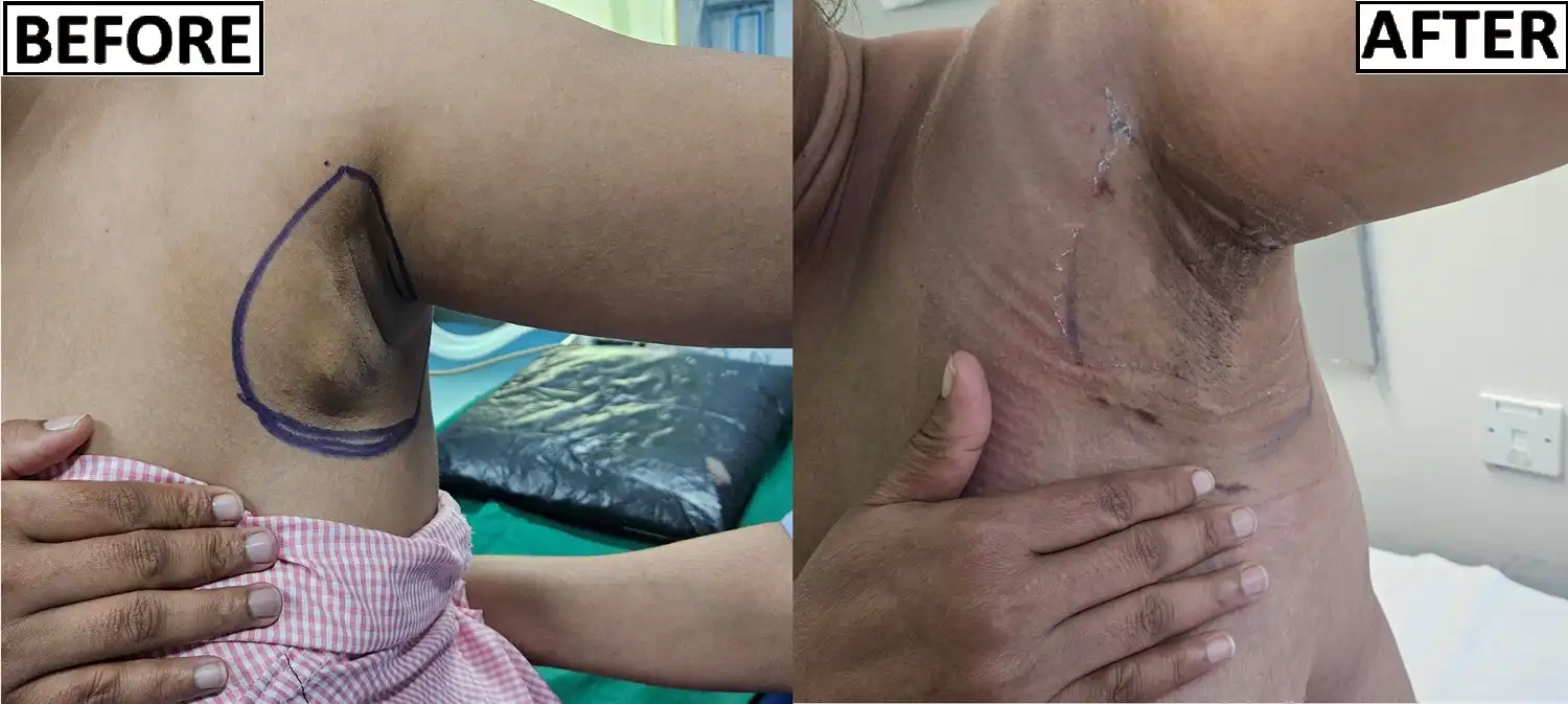 Axillary Breast