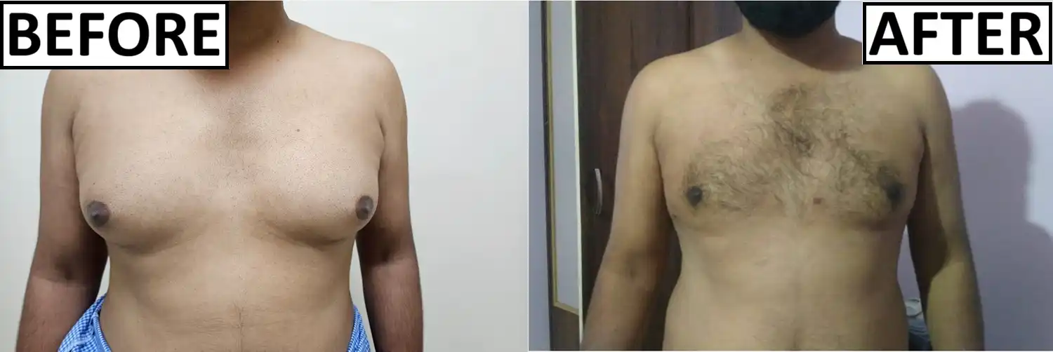 Gynaecomastia