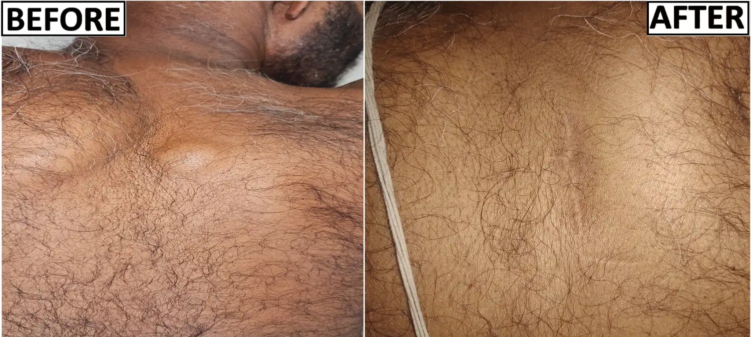 Sebaceous cysts
